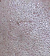 모공과 좁쌀 병변이 있는 피부 확대 사진